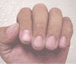 Fingernails carry disease