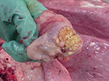 TB lesion
